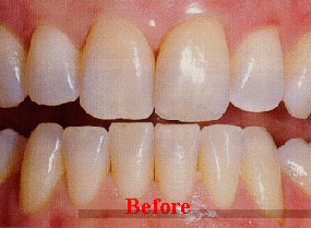 Bleachingbefore5a.jpg Bleachingbefore5a.jpg